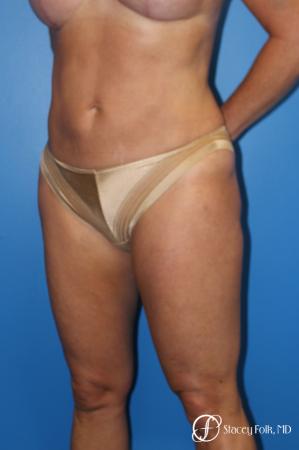 Denver Liposuction 10267 - After Image 2