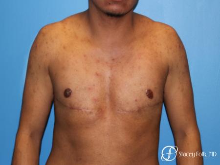 Denver FTM Female to male top surgery 5254 - After Image 1