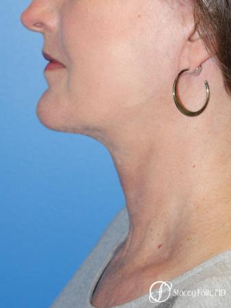 Denver Facial Rejuvenation Facelift, Blepharoplasty, Fat Transfer, Laser Resurfacing 10350 - After Image 1