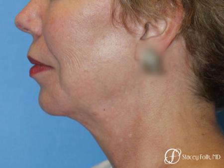 Denver Facial Rejuvenation Facelift, Fat Transfer, and Laser Resurfacing 8513 - After Image 1