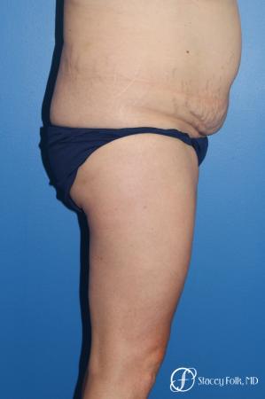 Denver Tummy Tuck (Abdominoplasty) and liposuction 10371 - Before and After Image 3