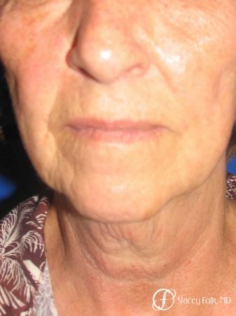 Denver Facial Rejuvenation Face Lift and Fat Injections 7129 - Before and After Image 3