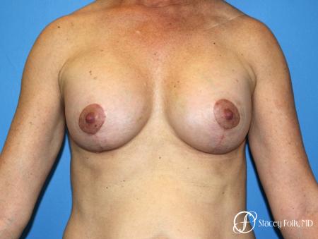 Denver Breast Augmentation Mastopexy 8163 - After Image 1