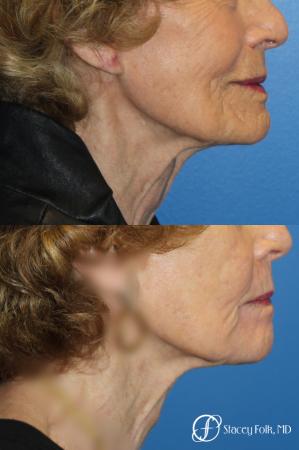Laser Skin Resurfacing - After Image 1