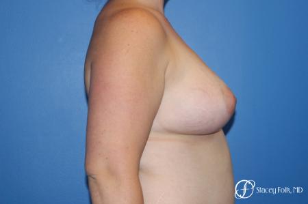 Fat Transfer To Right Breast - 1 After Image 3_2