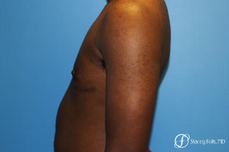 Denver FTM Female to male top surgery using gynecomastia technique 5497 - After Image 3