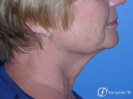 Denver Facial Rejuvenation Face Lift, Fat Injections, and Laser Resurfacing 7120 - Before Image 1