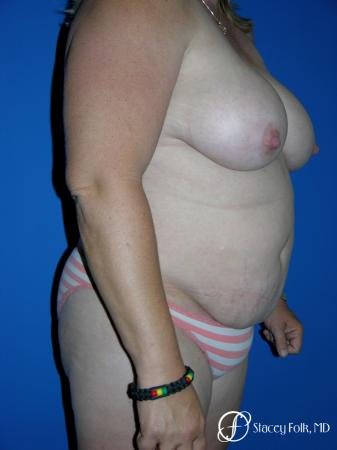 Denver Mommy makeover, breast reduction, abdominoplasty, liposuction 5355 - Before Image 2