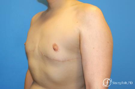 Denver FTM Top Surgery 5088 - After Image 2
