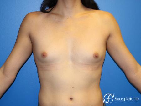 MTF (Male To Female Top Surgery) Breast Augmentation - Before Image 1