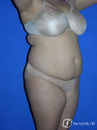 Denver Mommy makeover, breast reduction, abdominoplasty and liposuction 5353 - Before Image 2