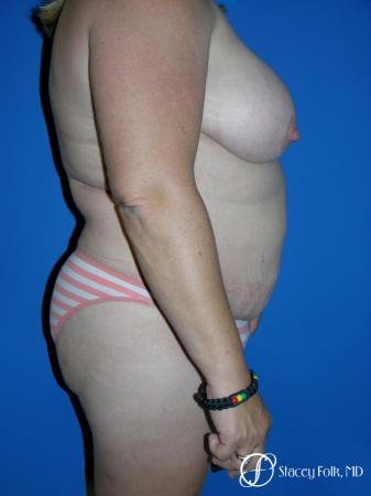 Denver Tummy Tuck 4783 - Before and After Image 3