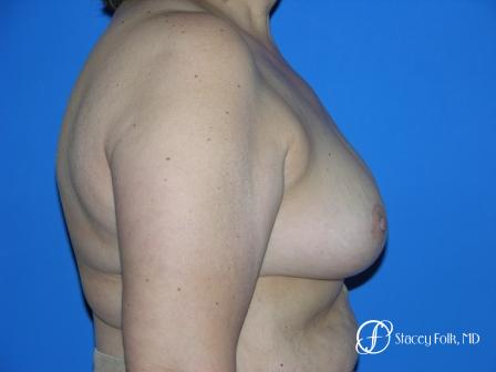 Denver Breast Reduction 55 - After Image 2