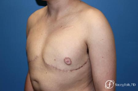 Denver Female to Male Top Surgery 5257 - After Image 4