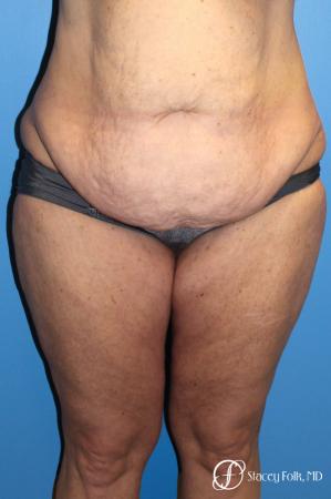 Denver Body Lift belt lipectomy, liposuction, mastopexy 5935 - Before Image 1