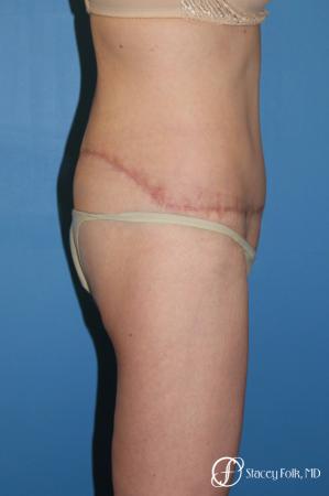 Denver Body Lift Belt lipectomy 5268 - After Image 3