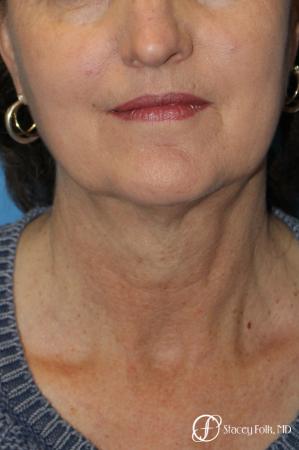 Denver Facial Rejuvenation Facelift, Blepharoplasty, Fat Transfer, Laser Resurfacing 10350 - Before Image 2