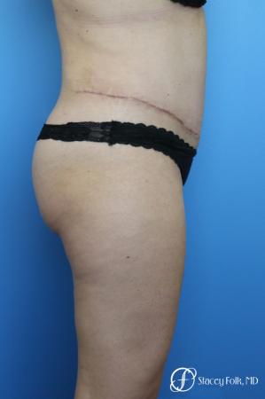Tummy Tuck (Abdominoplasty) and Liposuction - After Image 4