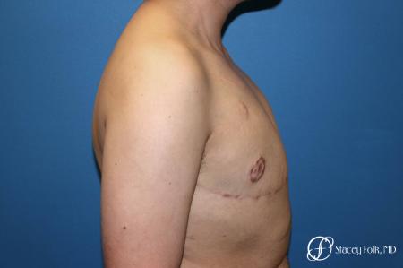 Denver Female to Male Top Surgery 5257 - After Image 3