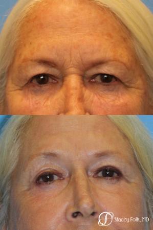 Upper Lid Blepharoplasty - Before Image 1