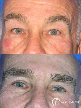 Denver Blepharoplasty 8273 - Before Image 1
