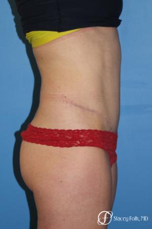 Denver Tummy Tuck - Abdominoplasty 8266 - After Image 2