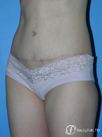 Denver Tummy Tuck - Abdominoplasty 10444 - After Image 2