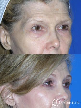 Denver Brow Lift and Upper Blepharoplasty 7161 - After Image 1