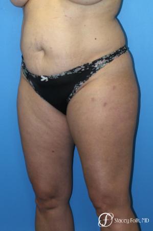 Tummy Tuck (Abdominoplasty) and Liposuction - Before Image 3