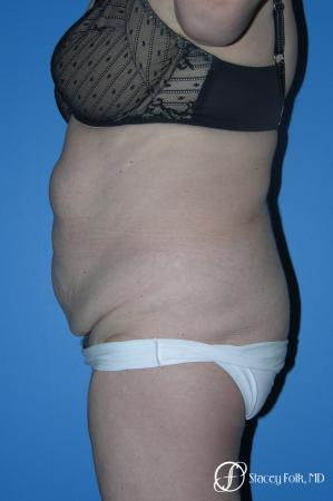 Denver Body Lift 4796 - Before and After Image 3