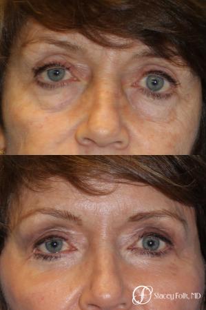 Denver Lower Lid Blepharoplasty 8640 - Before Image 1