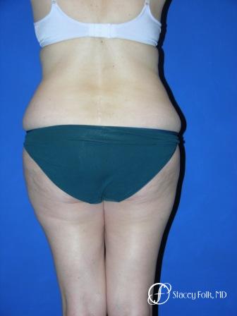 Denver Tummy Tuck 34 - Before and After Image 3