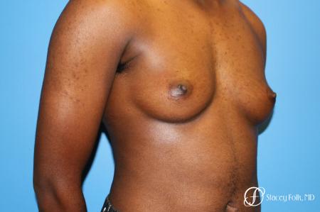 Denver FTM Female to male top surgery using gynecomastia technique 5497 - Before Image 2