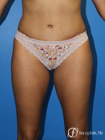 Tummy Tuck (Abdominoplasty) - After Image 1