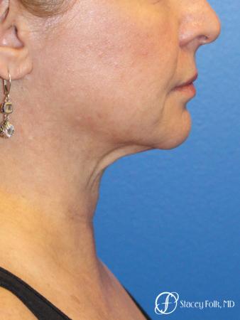 Denver Facial Rejuvenation 9894 - Before Image 1