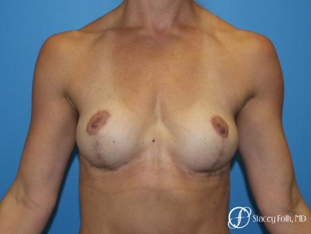 Denver Breast Lift - Mastopexy 8297 - After Image 1