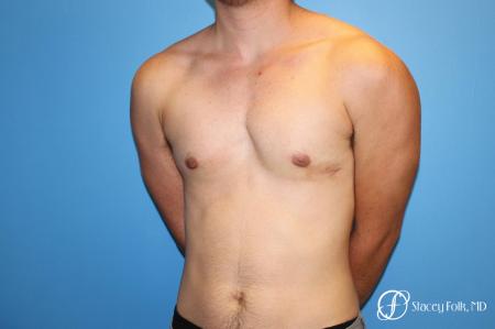 Denver FTM female to male top surgery using gynecomastia technique 5128 - 1 After Image 3