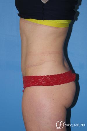 Denver Tummy Tuck - Abdominoplasty 8266 - After Image 3
