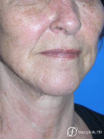 Denver Facial Rejuvenation Face Lift and Fat Injections 7129 - After Image 2