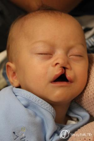Denver Cleft Lip and Palate Repair 10314 - Before Image 1