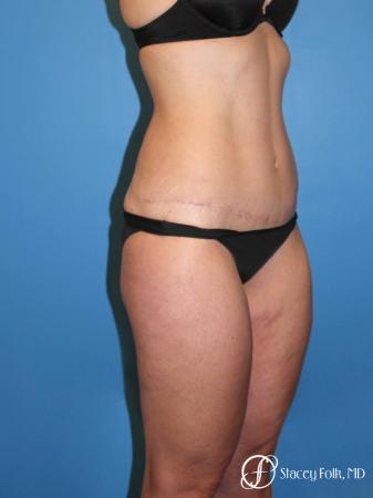 Denver Tummy Tuck Abdominoplasty and liposuction 4880 - After Image 2