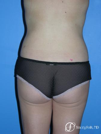 Denver Liposuction 3527 - After Image 2