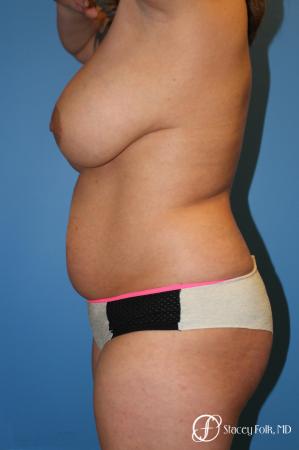 Denver Mommy Makeover 10298 - Before Image 2