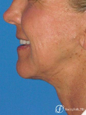 Denver Facial Rejuvenation Face Lift and Laser Resurfacing 7119 - After Image 1