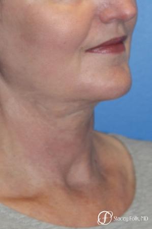 Denver Facial Rejuvenation Facelift, Blepharoplasty, Fat Transfer, Laser Resurfacing 10350 - After Image 3