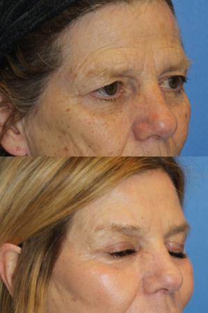 Denver Browlift and Blepharoplasty 11238 - After Image 1