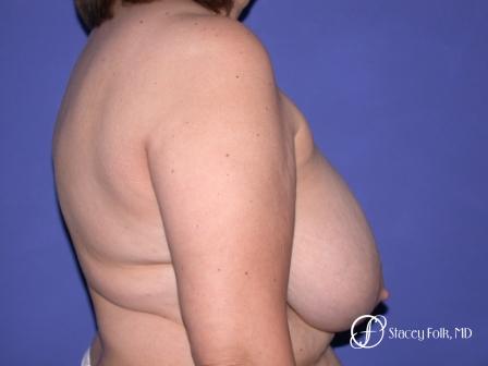 Denver Breast Reduction 55 - Before and After Image 2