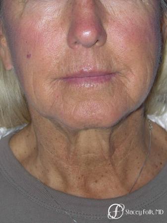 Denver Facial Rejuvenation Face Lift and Laser Resurfacing 7119 - Before and After Image 3