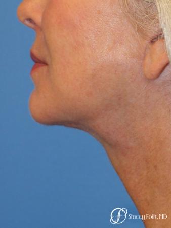 Denver Facelift & Laser Resurfacing 8277 - After Image 1