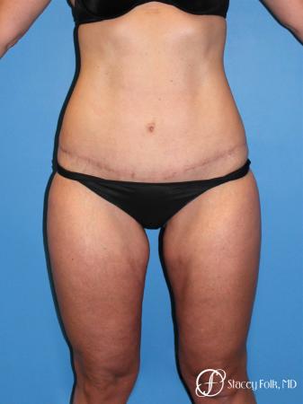 Denver Tummy Tuck Abdominoplasty and liposuction 4880 - After Image 1